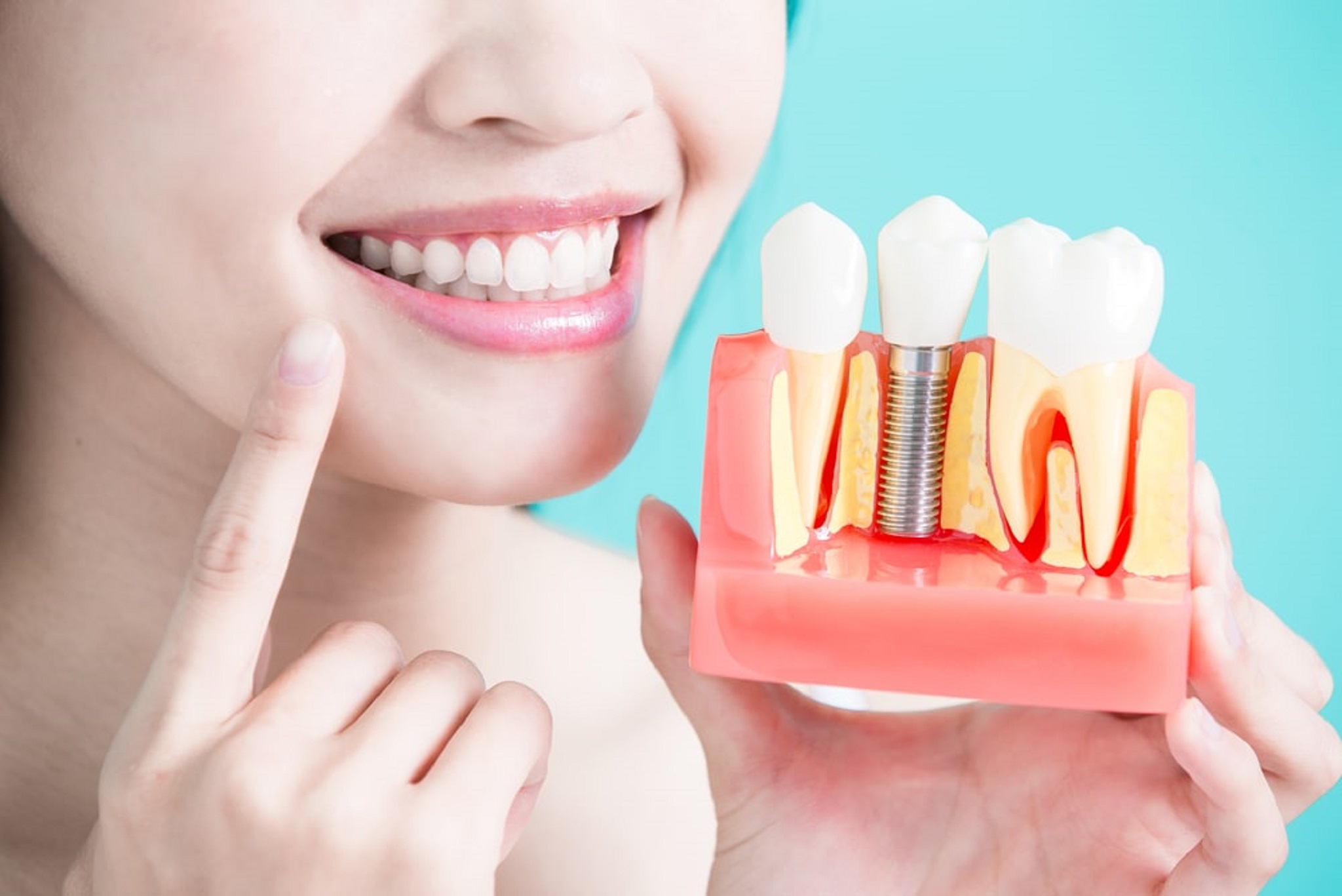 dental-implants