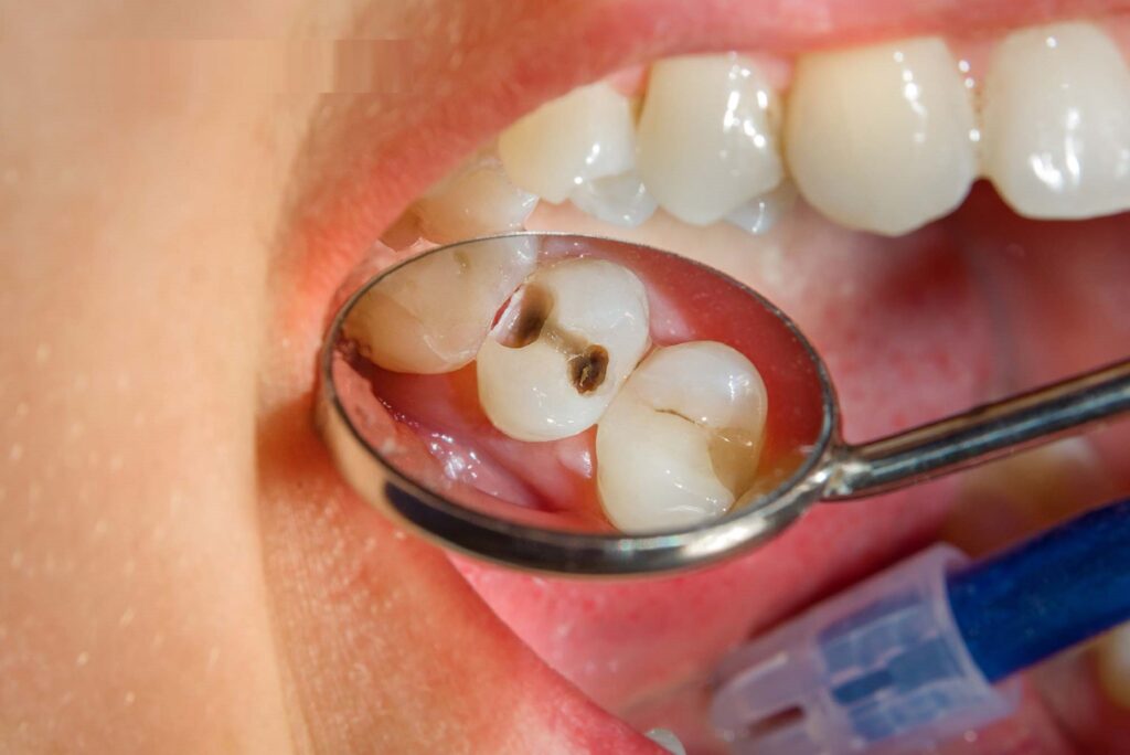 controlling-tooth-cavity-in-one-go-during-the-pandemic-with-a-dentist-in-bilaspur
