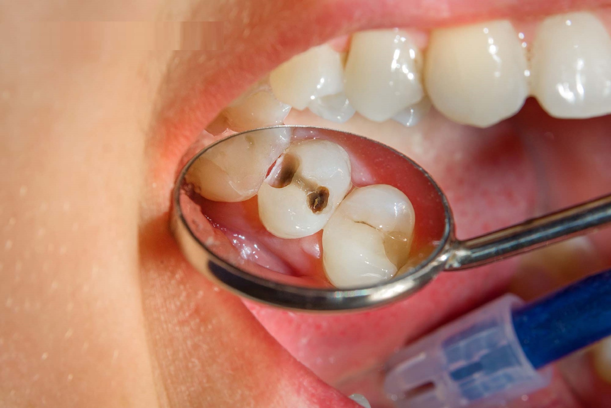 controlling-tooth-cavity-in-one-go-during-the-pandemic-with-a-dentist-in-bilaspur