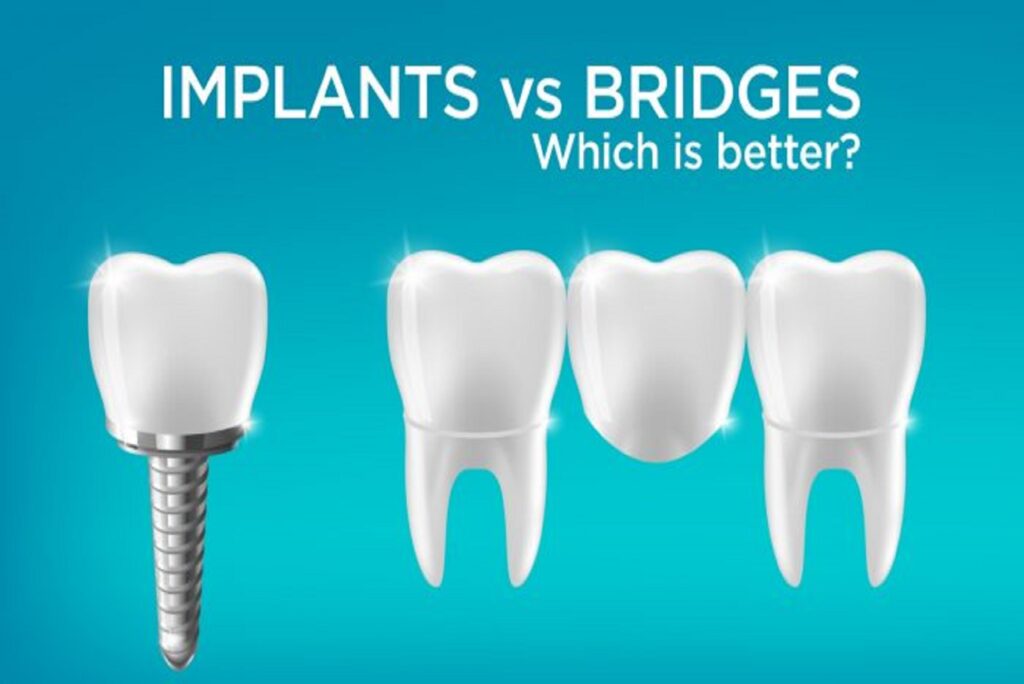Implant vs Bridge