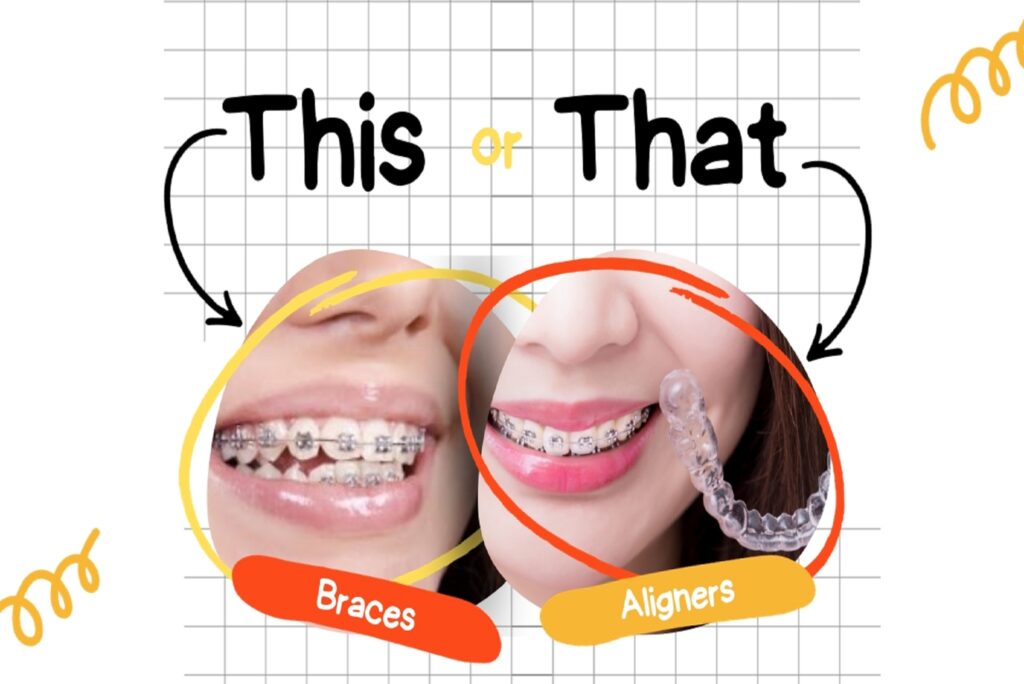 braces-or-clear-aligners